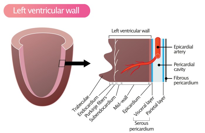 Chronic elevation of myocardial wall tension results in atrophy.